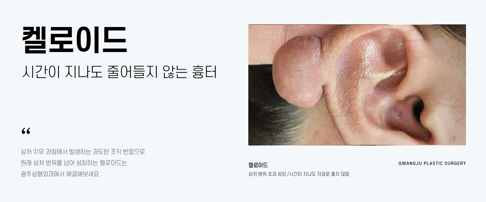 켈로이드