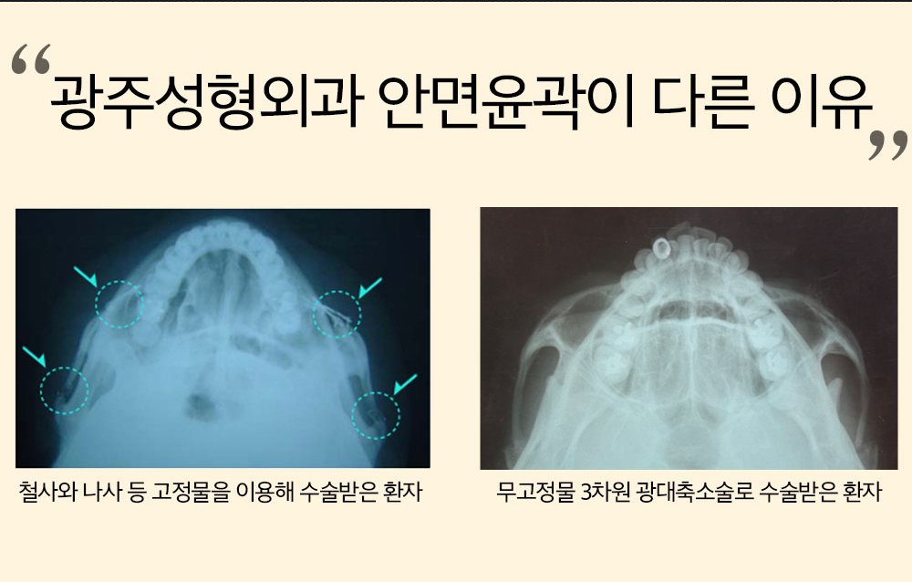 광주성형외과 고정물을 사용하는 광대수술과 무고정 퍼즐 3차원 광대축소술 비교 이미지