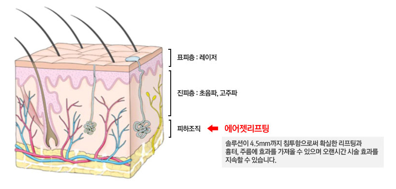 표피와 진피 아래 피하조직까지 구분한 에어젯 리프팅 적용 깊이 안내