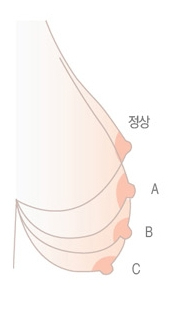 정상 가슴과 A급, B급, C급 유방하수 분류 안내