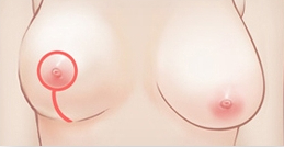 유륜 절개와 수직 절개를 이용한 처진 가슴 교정술 안내